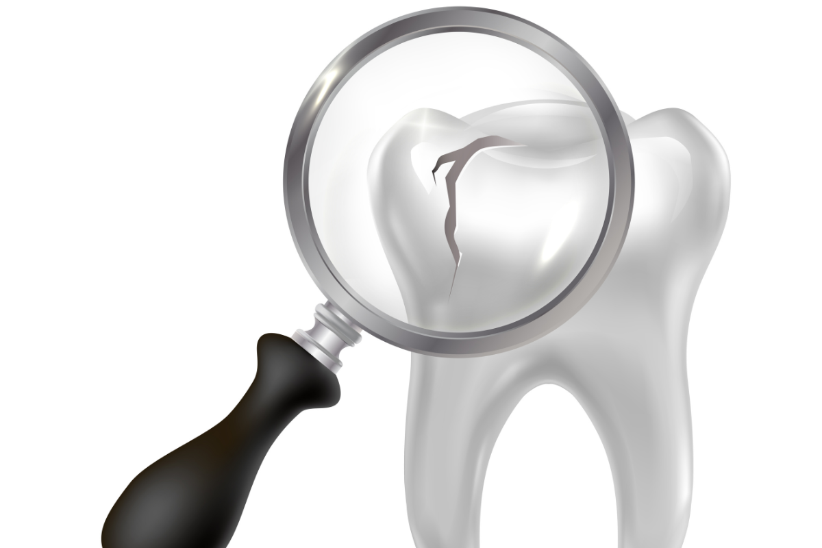 Caries (Tooth Decay)